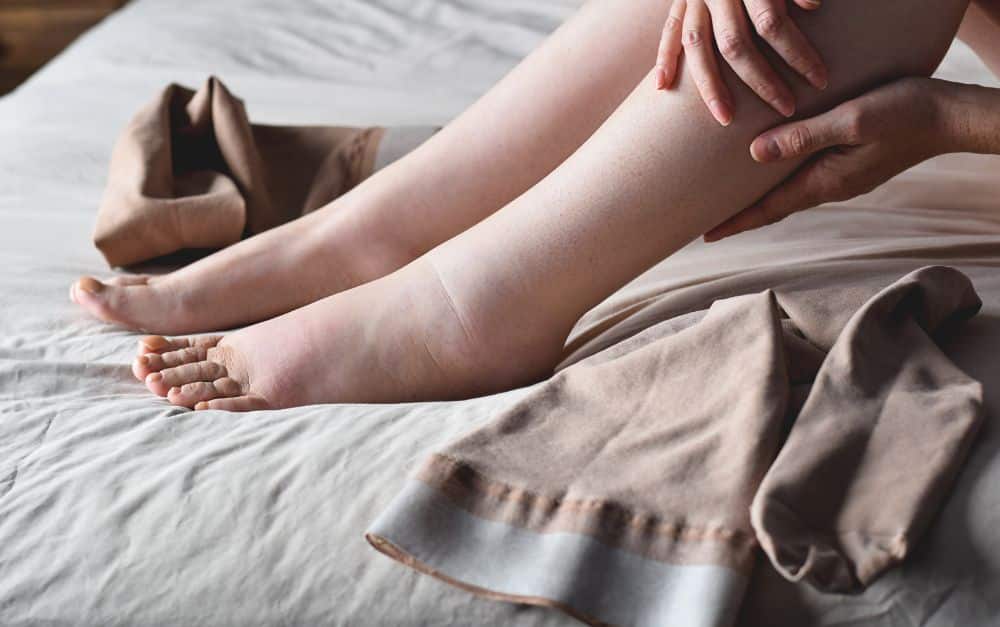 Geschwollene Beine: Wirksame Maßnahmen gegen dicke Beine und Füße